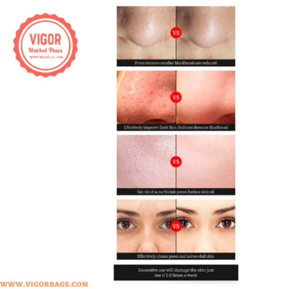 Premium Pimples Removal Deep Cleaning Tool Suction Blackhead Remover Device Elec - Picture 3 of 11